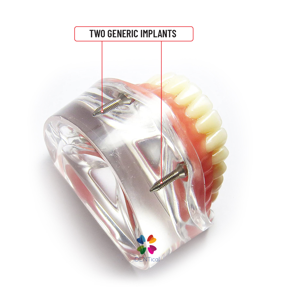 iDENTical Mandibular Overdenture Model with 2 Implants M6002