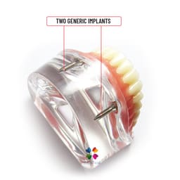 iDENTical Mandibular Overdenture Model with 2 Implants M6002 - 9