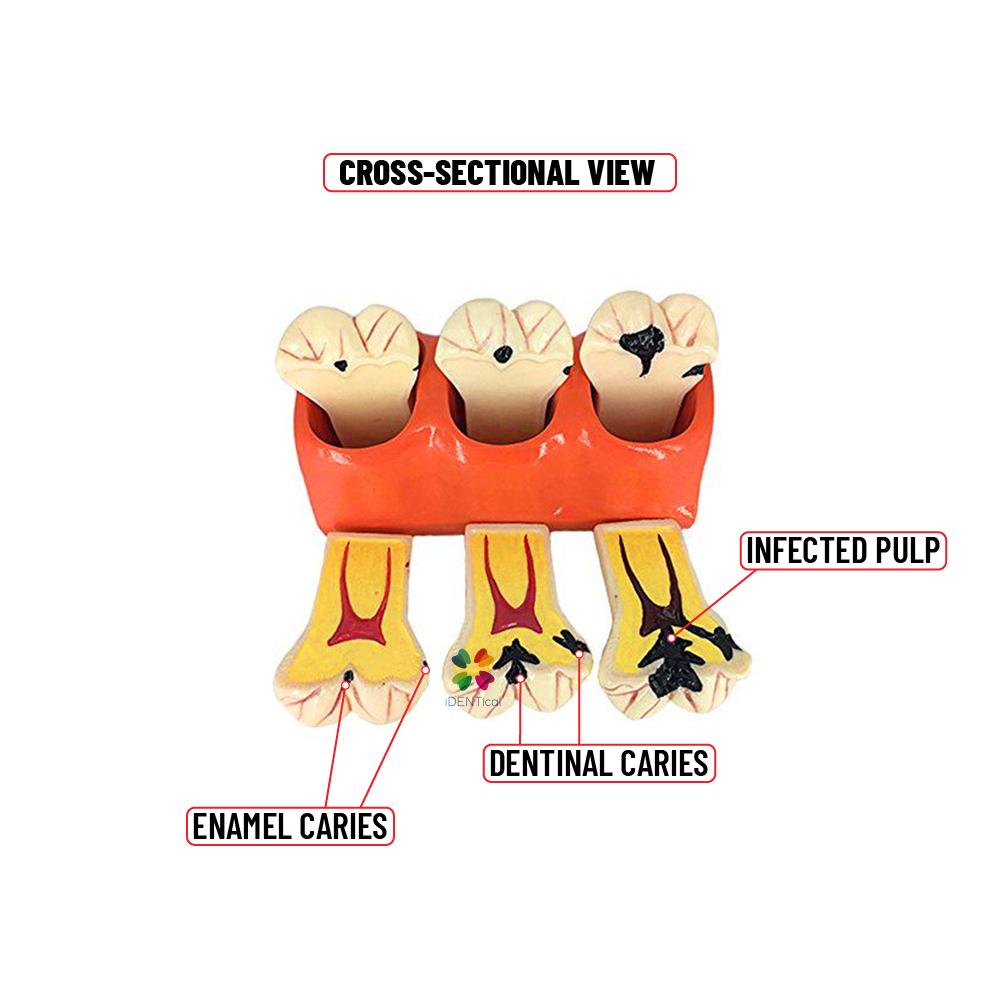 iDENTical Caries Development Tooth Model M4020