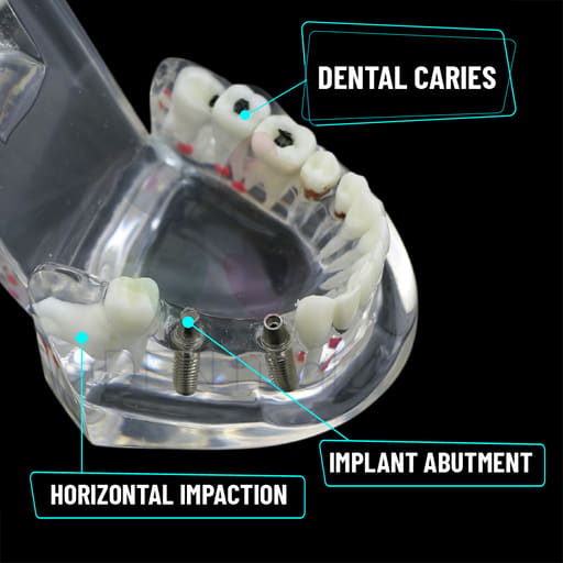 iDENTical All In One Dental Implant Model - M2001 (White)