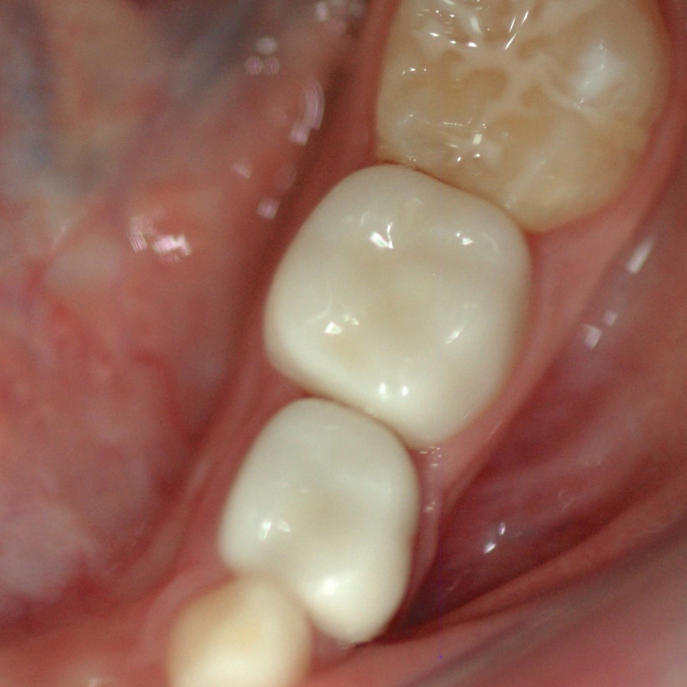 Kids-e-Crown Zirconia Lower Left 2nd Molar Refills