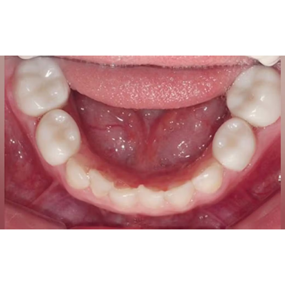 Kids-e-Crown Zirconia Lower Right 2nd Molar Refills