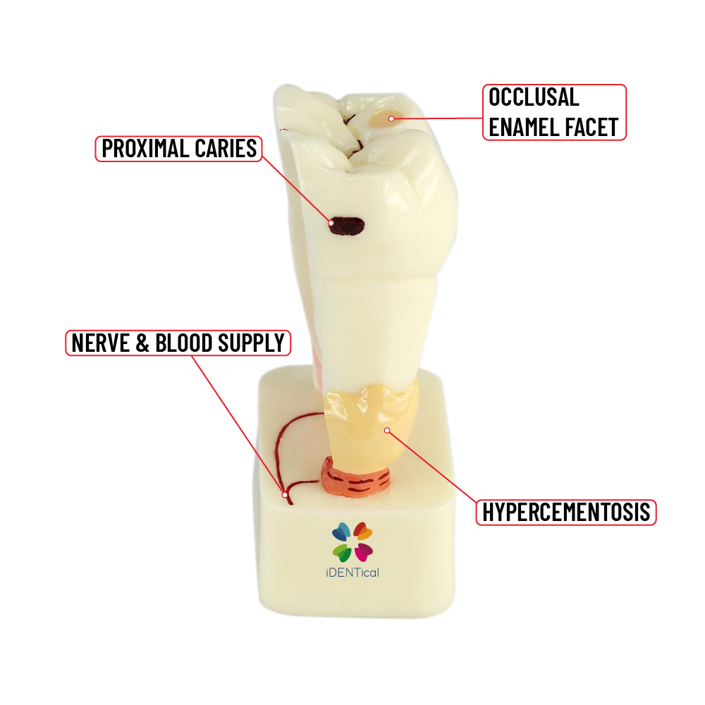 iDentical 4X Pathologies Of Tooth Model - M4015