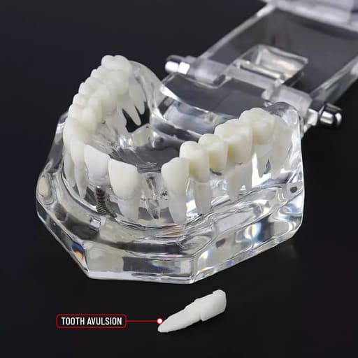 iDENTical All In One Dental Implant Model - M2001 (White)