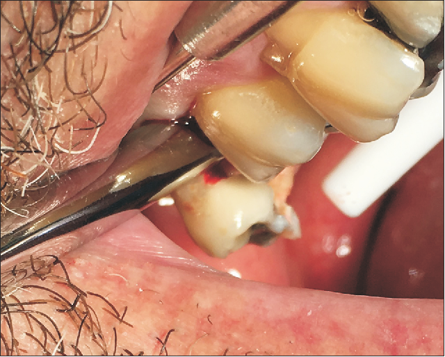 Oracraft Root Elevator Bein