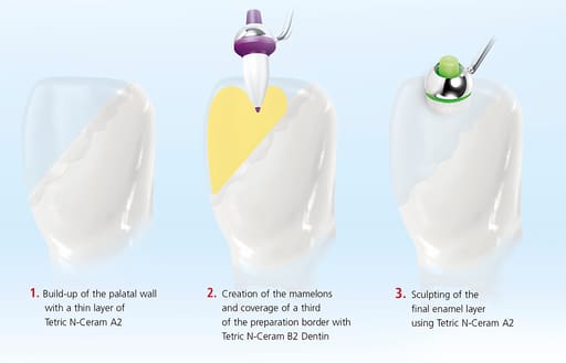 Ivoclar Tetric N-Ceram Composite Refill