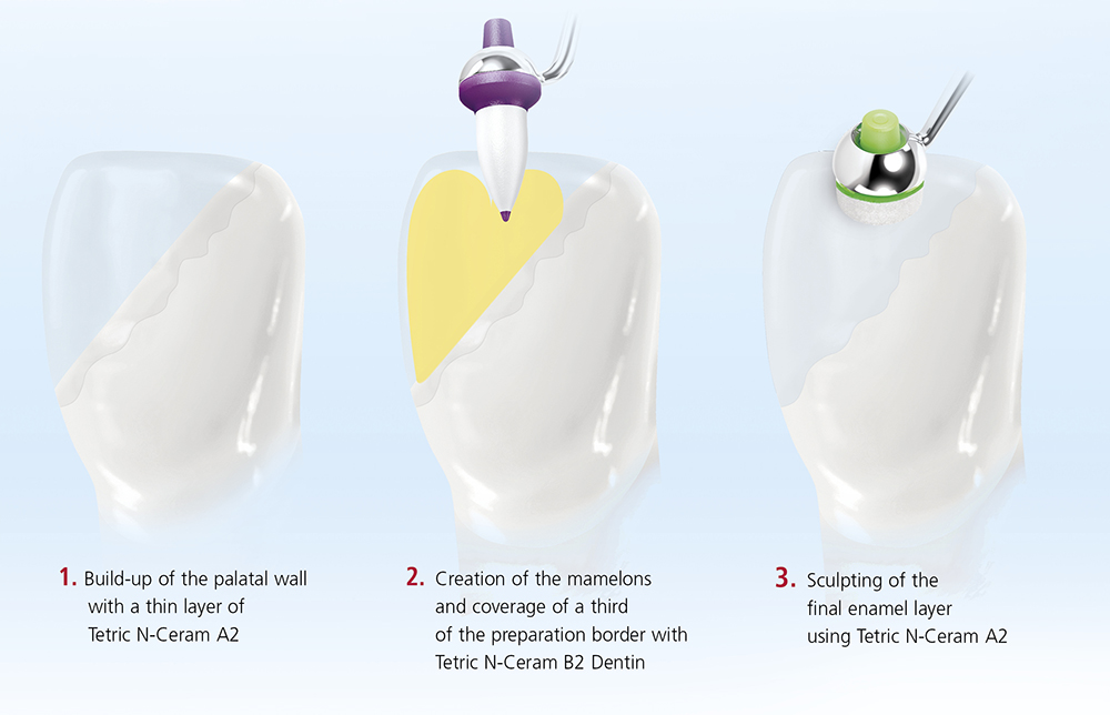 Ivoclar Tetric N Ceram Composite Kit & Refills
