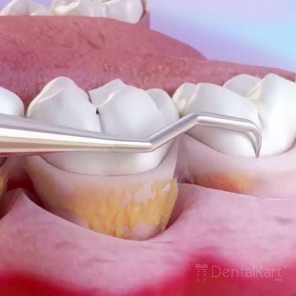 Waldent Gracey Curettes Set of 7 