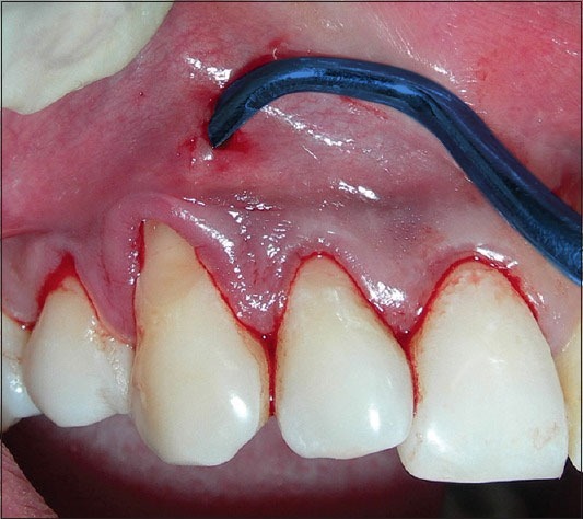 Waldent Vista Tunneling Procedure Kit Set of 6 (K22/1)