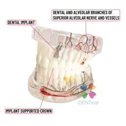 iDENTical Patient Education Model (Caries,implant,Nerves) M2001-3 - 5