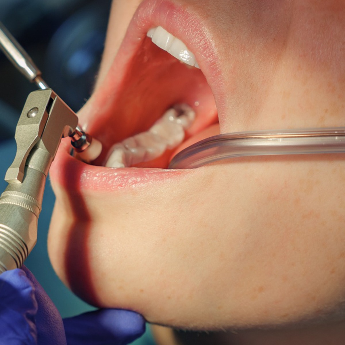 Waldent Saliva Ejector - Blue Tip (Pack Of 100 With Copper Wire)