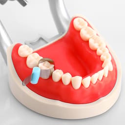 ET Dental Automatrix Metal Bands With Locker - 16