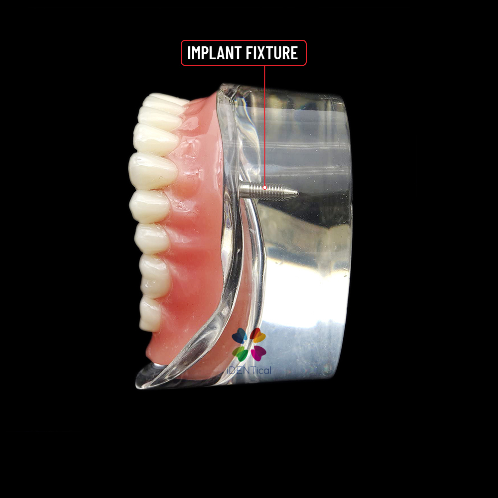 iDENTical Mandibular Overdenture Model with 2 Implants M6002