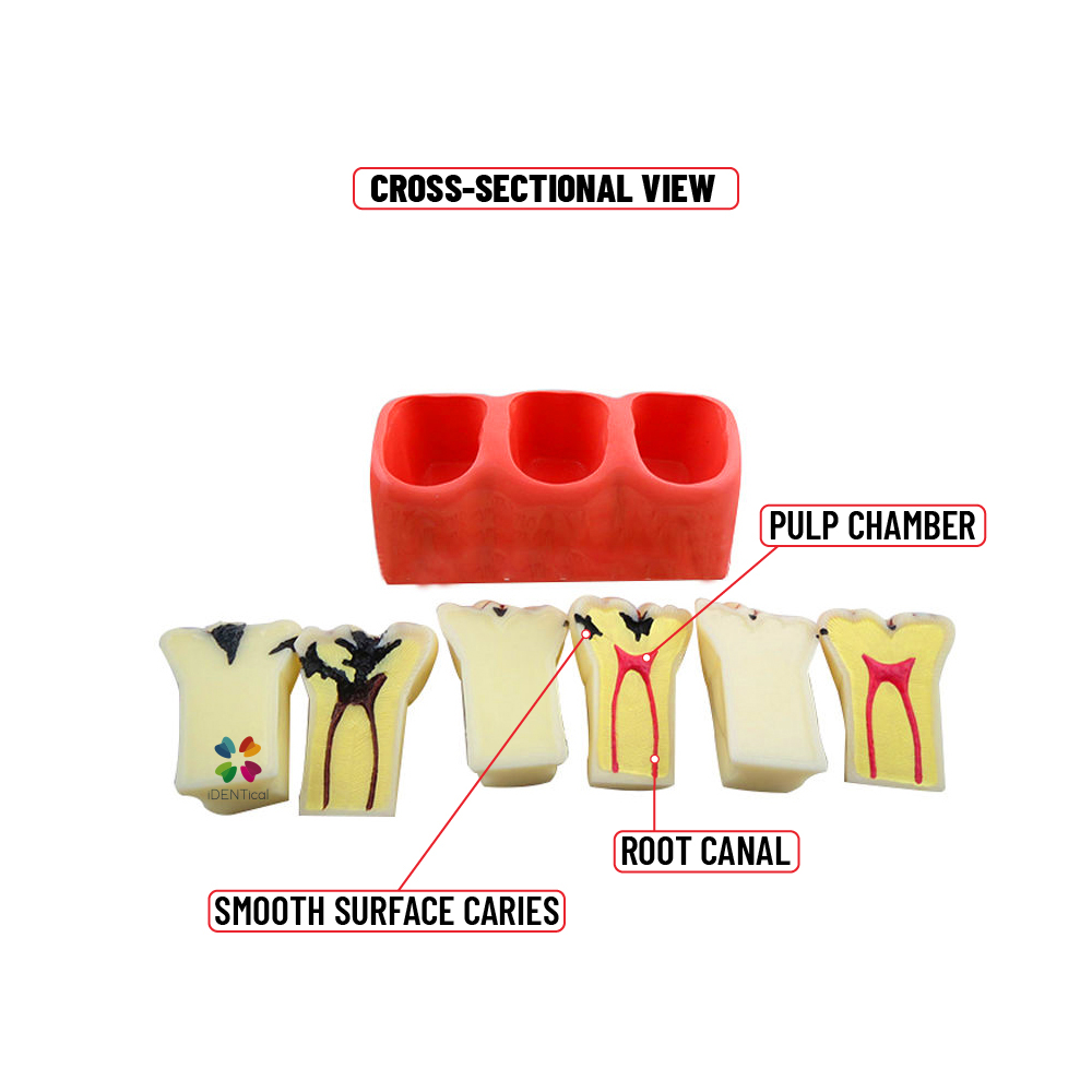 iDENTical Caries Development Tooth Model M4020