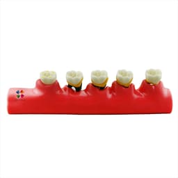 iDENTical Stages Of Periodontitis Model - M4010 - 3