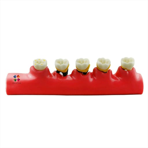 iDENTical Stages Of Periodontitis Model - M4010