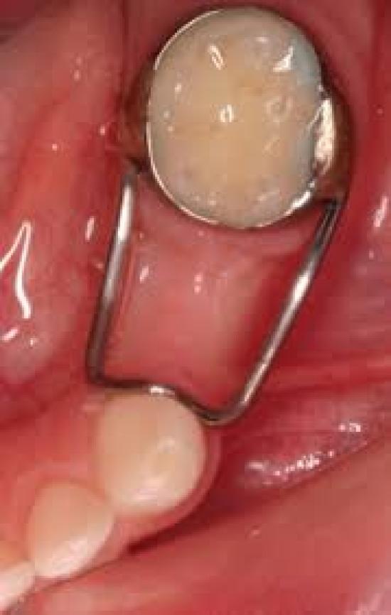 Kids-e-Dental Curved Loops (Pk of 10)