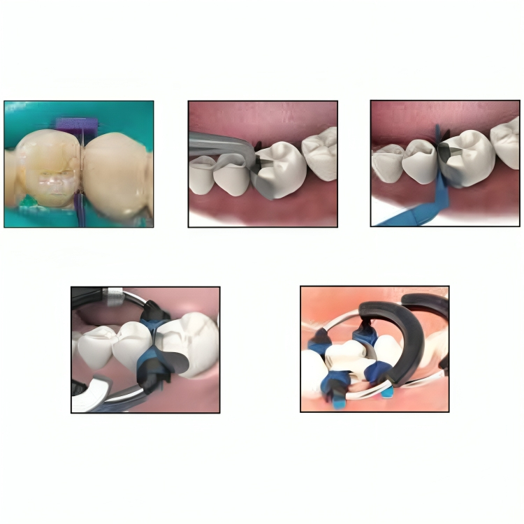 Garrison Dental Composi-Tight 3D Soft Face Ring (3D500-1)