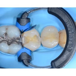 Garrison Dental Composi-Tight 3DXR Ring (3DXR-1) - 2