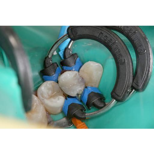 Garrison Dental Composi-Tight 3DXR Ring (3DXR-1)