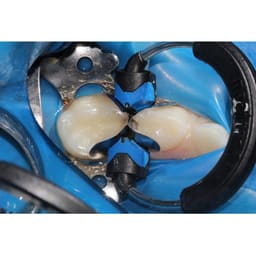 Garrison Dental Composi-Tight 3DXR Ring (3DXR-1) - 4
