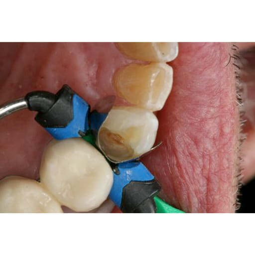 Garrison Dental Composi-Tight 3DXR Ring (3DXR-1)