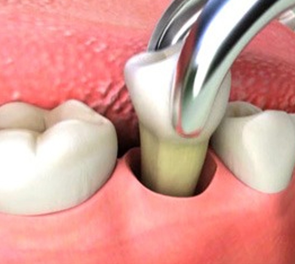 Waldent Extraction Forceps Kit Set of 14 (K1/7)