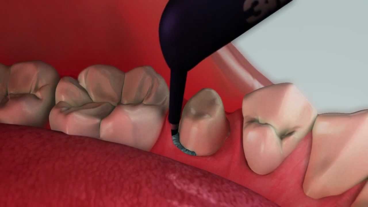 3M ESPE Astringent Retraction Material - Paste