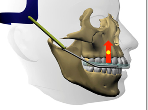 Leone Headgear Highpull 1/pk