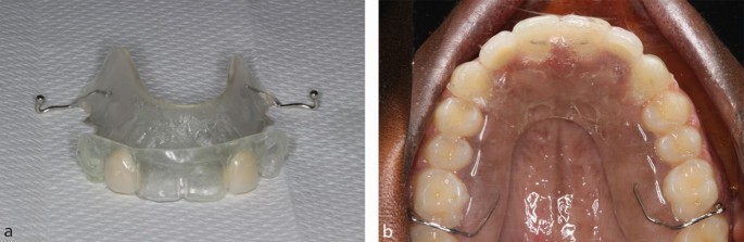 Dentaurum Orthocryl EQ Powder Polymer Clear 1 Kgs - 160-300-00