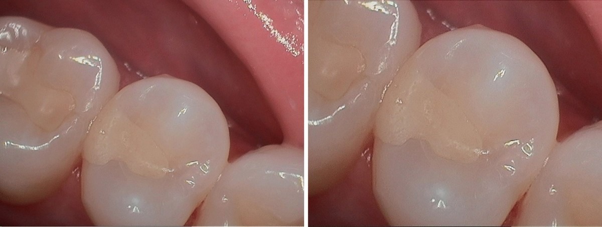 Wizdent Secure Core Z