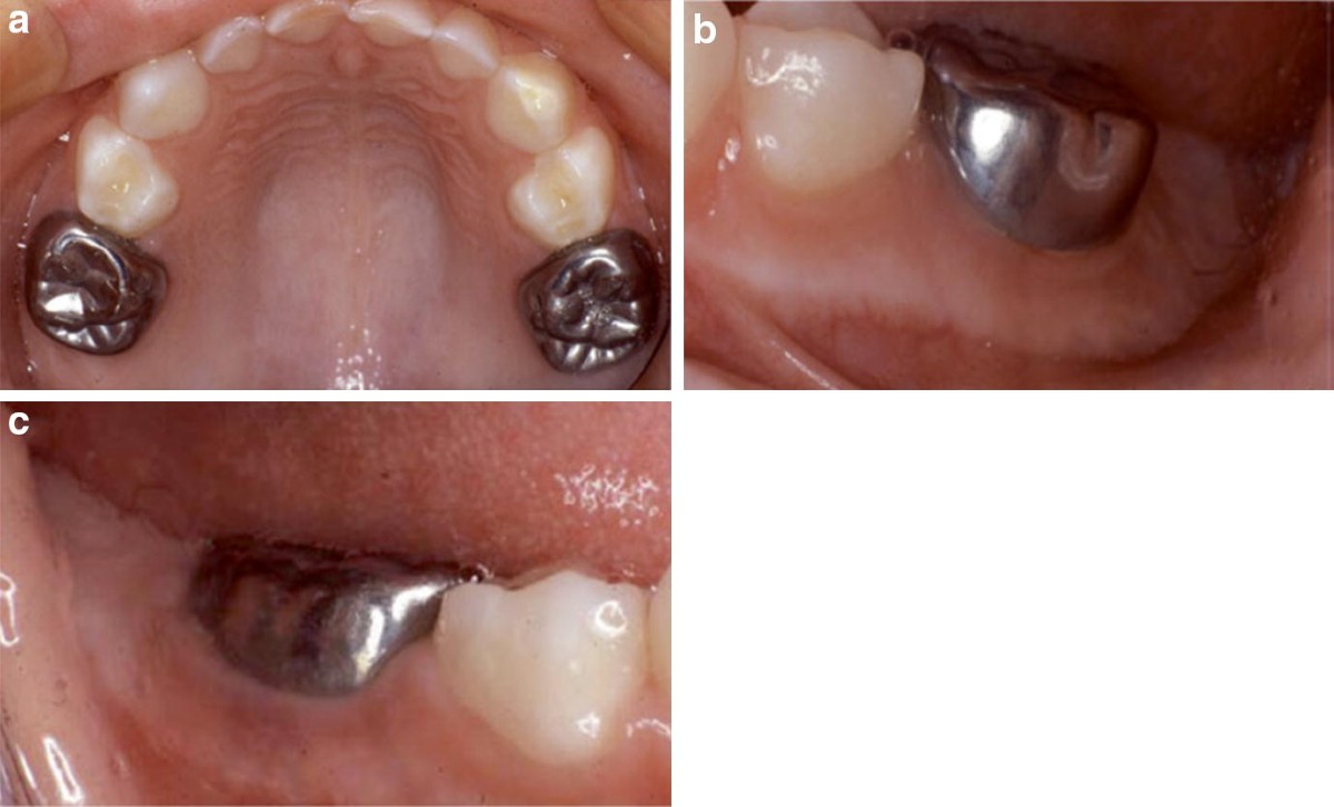 Oro SS Little Crown Primary Molar - E (2nd Molar)