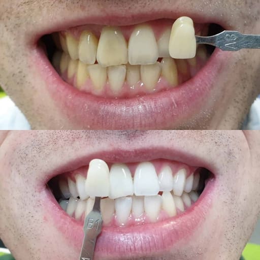 Maarc Blitz White Bleaching Kit (8801/001)