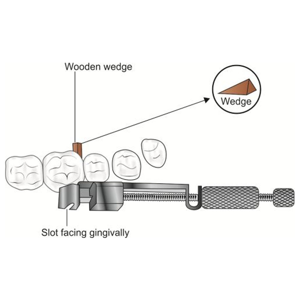 GDC Tofflemire Matrix Retainer (Mrtu)