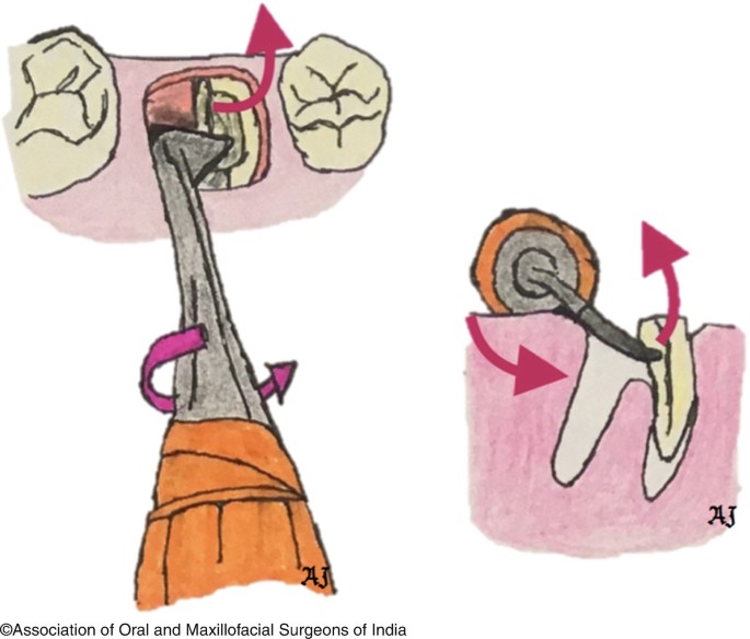 Oracraft Seldin Root Elevator