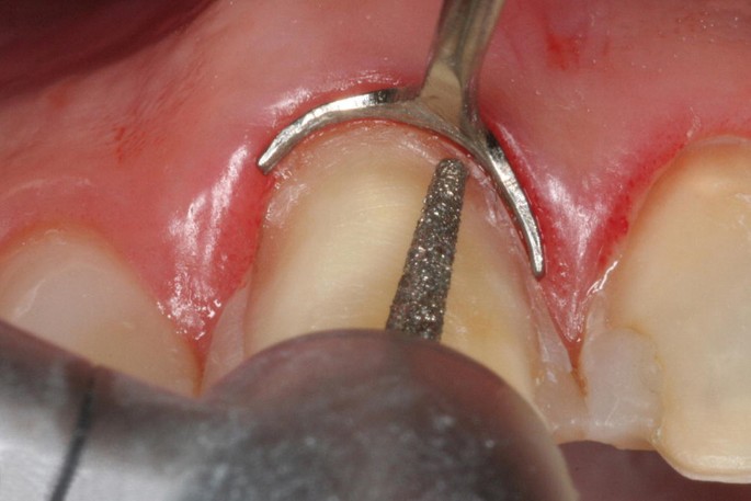 Prima Dental Taper Flat End Bur FG (Pack Of 5 Burs)