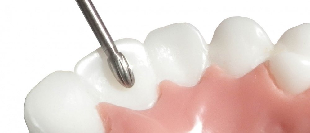 Prima Dental Orthodontic Debonding Bur (safe end)