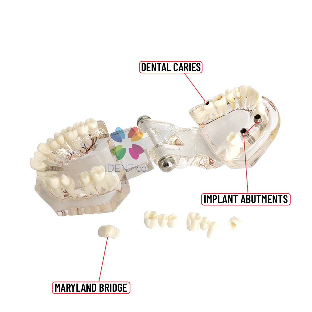 iDENTical Patient Education Model (Caries,implant,Nerves) M2001-3