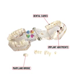 iDENTical Patient Education Model (Caries,implant,Nerves) M2001-3 - 4