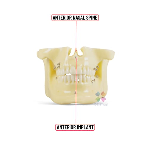 iDENTical Orthodontic Implant Model - M2016