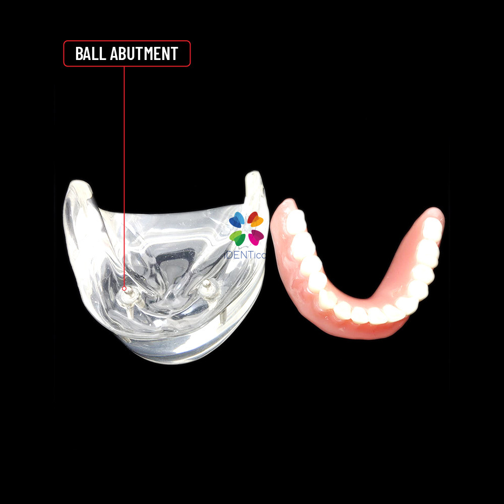 iDENTical Mandibular Overdenture Model with 2 Implants M6002