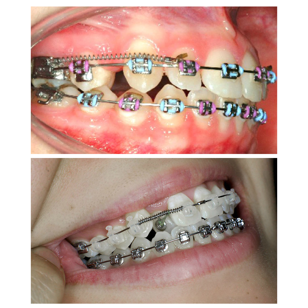 U Ortho NiTi Open Spring 0.010 Inch 180mm