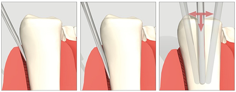 Waldent Luxator Set Of 4 (K11 /1)