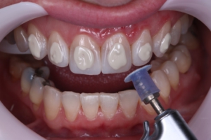 Shofu Direct Dia Diamond Polishing Paste