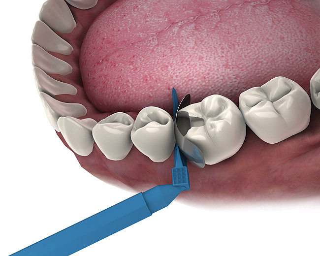 ET Dental Sectional Contoured Matrices Refill