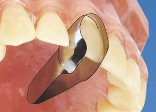 Tor Vm Anterior Metal Matrices and Strips
