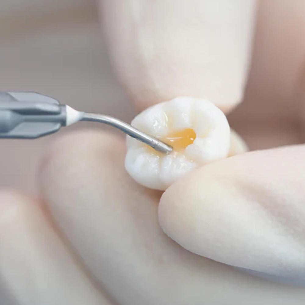 Vincismile Trusfil-flow Flowable Composite 