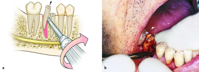 GDC Root Elevator Set Of 9 In Pouch (RESP9)