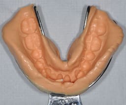 Waldent Rim-Lock Impression Trays - 15
