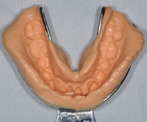 Waldent Rim-Lock Impression Trays